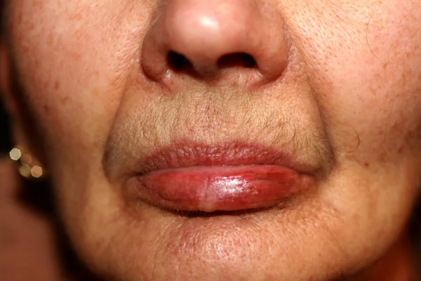 Verweerde lippen. Koorts op de lip. Herpes. — Stockfoto