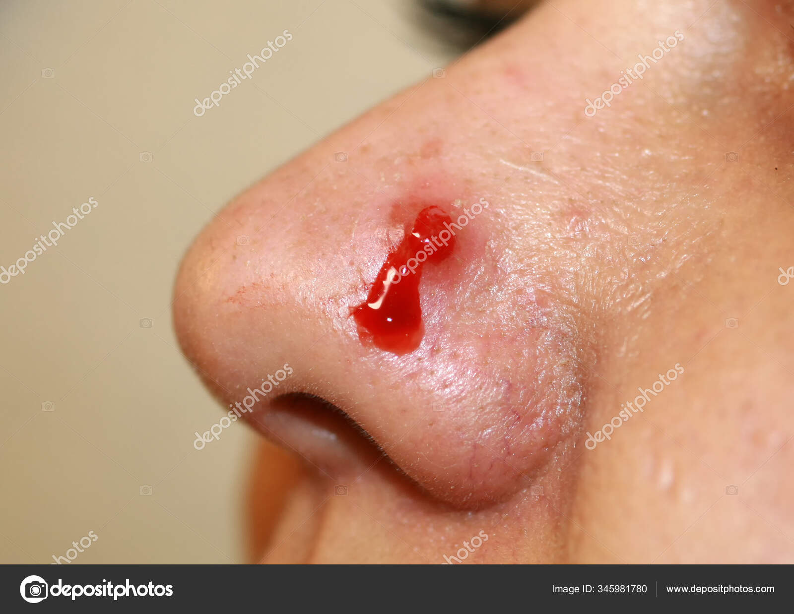 Bouton enflammé sur le nez. Acné kystique. L'acné sur la peau ...