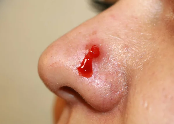 Zánět pupínku na nose. Cysta Acne. Akné na kůži — Stock fotografie