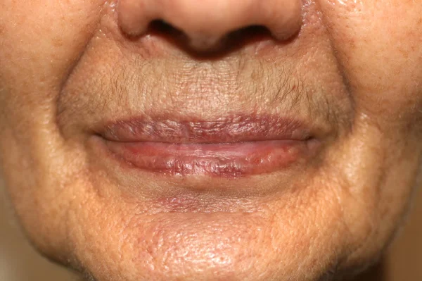 Nasolabial wrinkles. Wrinkles on the skin of the face of the neck. Flabby cheeks and neck