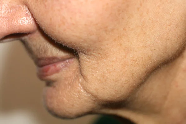 Zmarszczki błony śluzowej nosa. Zmarszczki na skórze twarzy szyi. Obwisłe policzki i szyja — Zdjęcie stockowe