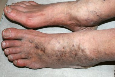 Bacak. Varis. Flebeurysm. Tromboflebit. damarlarda bacak