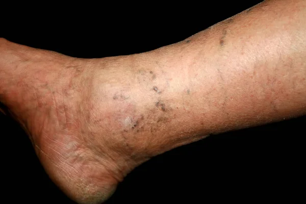 Bein. Krampfadern. Phlebeurysmus. Thrombophlebitis. Bein in Adern. — Stockfoto