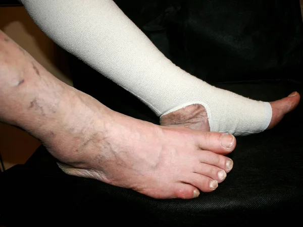 Leg. Varicose, veins. Phlebeurysm. Thrombophlebitis. Elastic bandage. — Stock Photo, Image