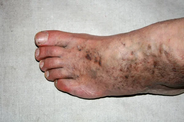 Bein. Krampfadern. Phlebeurysmus. Thrombophlebitis. Bein in Adern — Stockfoto