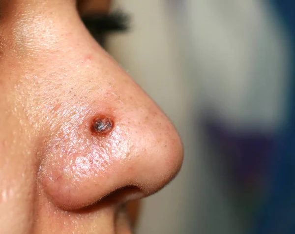 Inflamed pimple on nose. Cyst Acne. Acne on the skin — Stockfoto