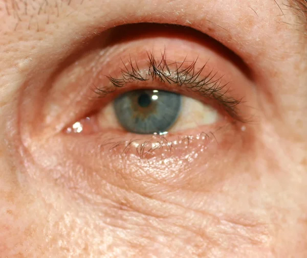 Rugas debaixo dos olhos. Rugas na pele do rosto. Pálpebras flácidas — Fotografia de Stock