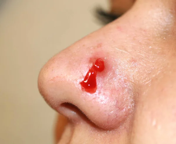 Bouton enflammé sur le nez. Acné kystique. L'acné sur la peau — Photo