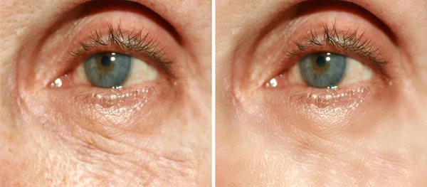 Arrugas debajo de los ojos. Arrugas en la piel de la cara. Párpados flácidos. Antes y después del tratamiento con un procedimiento cosmético — Foto de Stock