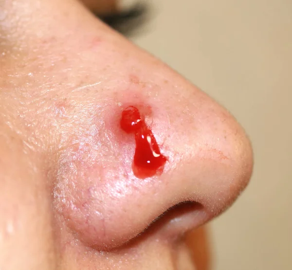 Inflamed pimple on nose. Cyst Acne. Acne on the skin — Stock Photo, Image