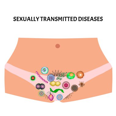 Viral ve bakteriyel enfeksiyonlar. Cinsel yolla bulaşan hastalıklar. Bilgi grafikleri. İzole edilmiş arkaplanda vektör illüstrasyonu.
