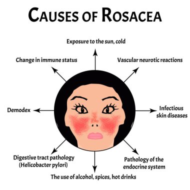 Rosacea 'nın nedenleri. Rosacea Farkındalık Ayı. Bilgi grafikleri. İzole edilmiş arkaplanda vektör illüstrasyonu.