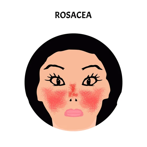 Rosacea. Il mese della consapevolezza della Rosacea. Infografica. Illustrazione vettoriale su sfondo isolato . — Vettoriale Stock