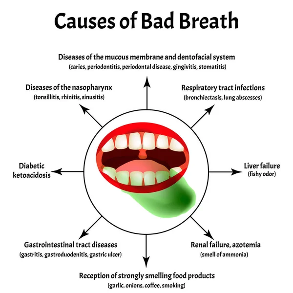 Causas de mal aliento. Halitosis. La estructura de los dientes y la cavidad oral. Enfermedades de los dientes. Infografías. Ilustración vectorial sobre fondo aislado . — Vector de stock