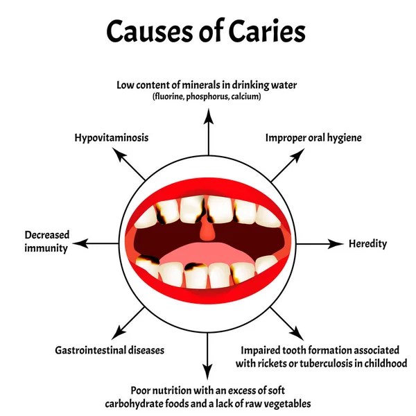 Причини карієсу. Пахне від рота. Халітоз. Структура зубів і ротової порожнини. Хвороби зубів. Інфографіка. Вікторна ілюстрація на ізольованому тлі. — стоковий вектор