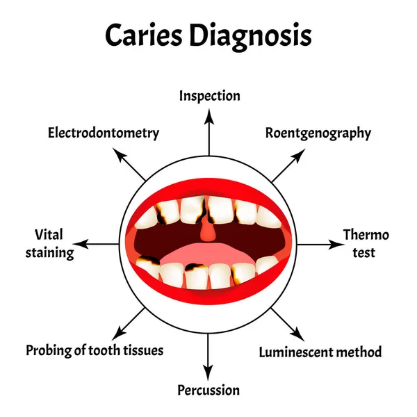 Diagnóza caries. Špatný dech. Halitóza. Struktura zubů a dutiny ústní s caries. Nemoci zubů. Infographics. Vektorová ilustrace na izolovaném pozadí. — Stockový vektor