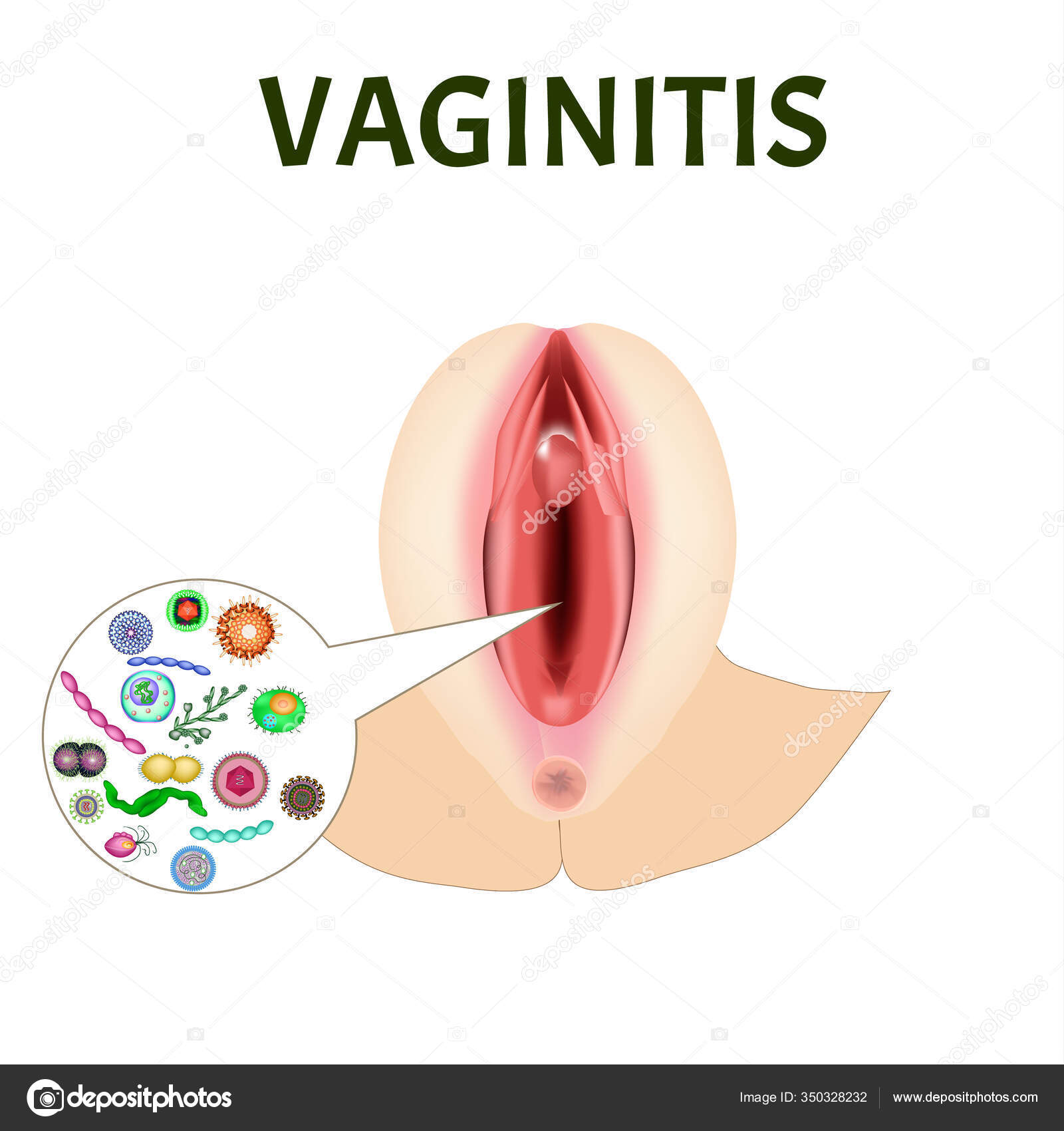 Tratamento de supositórios de vaginite. inflamação da vagina. Infográficos.  ilustração vetorial em fundo isolado imagem vetorial de mikrostoker©  136049596