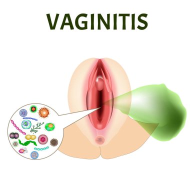 Vajinalar. Kadın üreme organı iltihabı. Üreme organlarının yapısı. Vajinal disbiyoz geçiriyor. Kötü kokuyor. Bilgi grafikleri. İzole edilmiş arkaplanda vektör illüstrasyonu.
