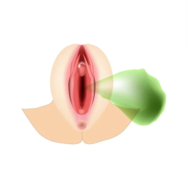 Vaginitis. Vrouwelijke genitale ontsteking. De structuur van de voortplantingsorganen. Vaginitis vaginale dysbiose. Slechte geur. Infografieën. Vectorillustratie op geïsoleerde achtergrond. — Stockvector