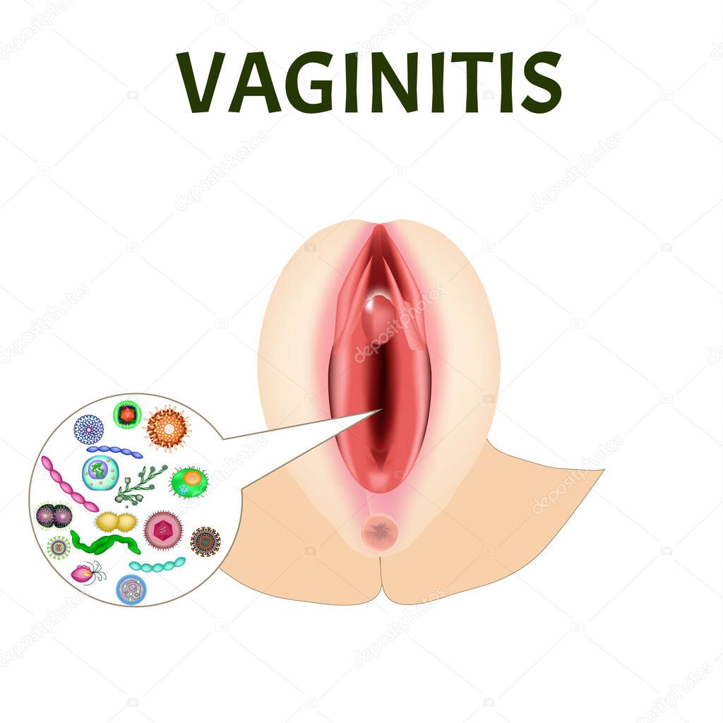 Vaginitis. Female genital inflammation. The structure of the reproductive organs. Vaginitis vaginal dysbiosis. Infographics. Vector illustration on isolated background.