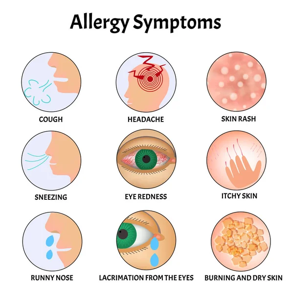 Síntomas de alergias Erupción cutánea, picor alérgico en la piel, lagrimeo en los ojos, tos, estornudos, secreción nasal, dolor de cabeza, enrojecimiento de los ojos. Alergia a la infografía. Ilustración vectorial en aislado — Vector de stock