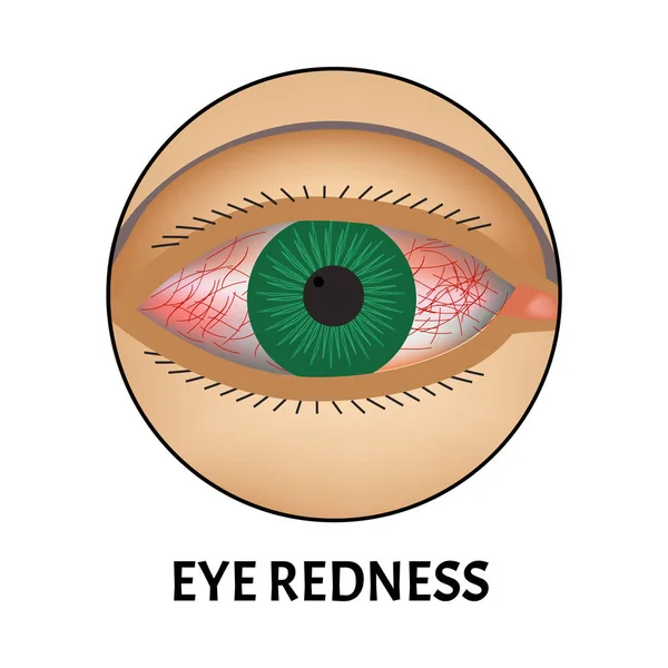 Gözlerin kızarıklığı. Konjonktivit, alerji, gözlerde iltihap belirtileri. Göz kırmızısı simgesi. Bilgi grafikleri. İzole edilmiş arkaplanda vektör illüstrasyonu. — Stok Vektör