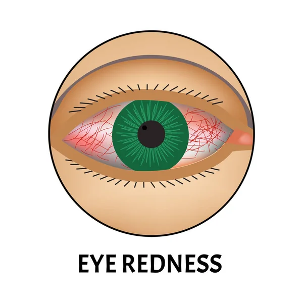 Vermelhidão dos olhos. Sintoma de conjuntivite, alergias, inflamação dos olhos. Ícone de vermelhidão ocular. Infográficos. Ilustração vetorial sobre fundo isolado . —  Vetores de Stock