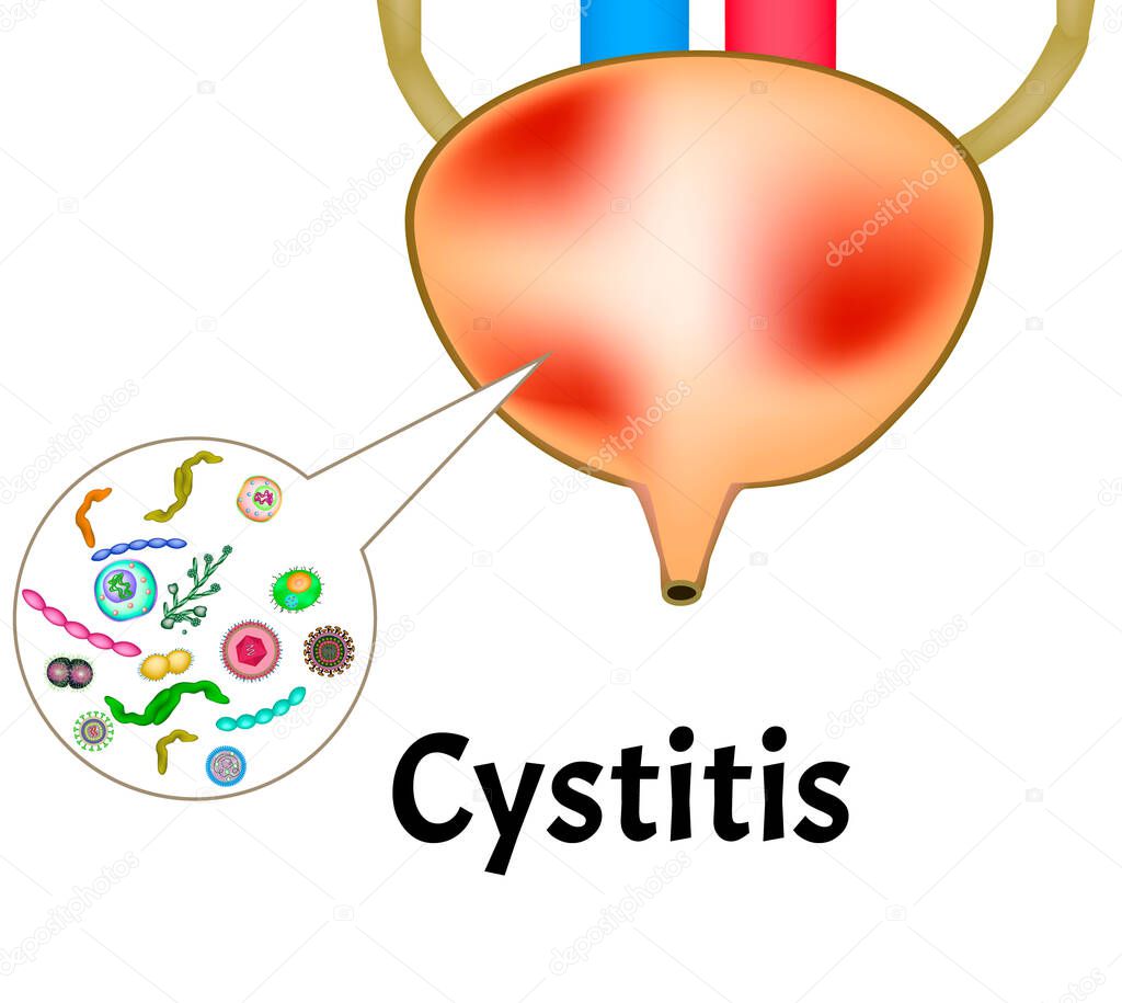 Cystitis. Inflammation of the bladder. The structure of the kidneys and bladder. Excretory system. Infographics. Vector illustration on isolated background.