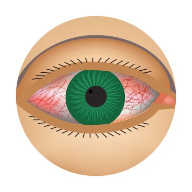 Redness of the eyes. Symptom of conjunctivitis, allergies, inflammation of the eyes. Eye redness icon. Infographics. Vector illustration on isolated background. clipart