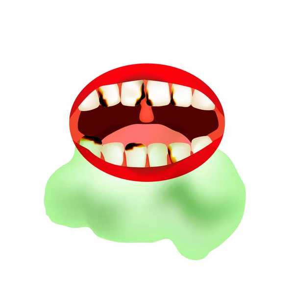 Caries. Smrdí to z pusy. Halitóza. Struktura zubů a dutiny ústní. Nemoci zubních kazu. Infographics. Vektorová ilustrace na izolovaném pozadí. — Stockový vektor