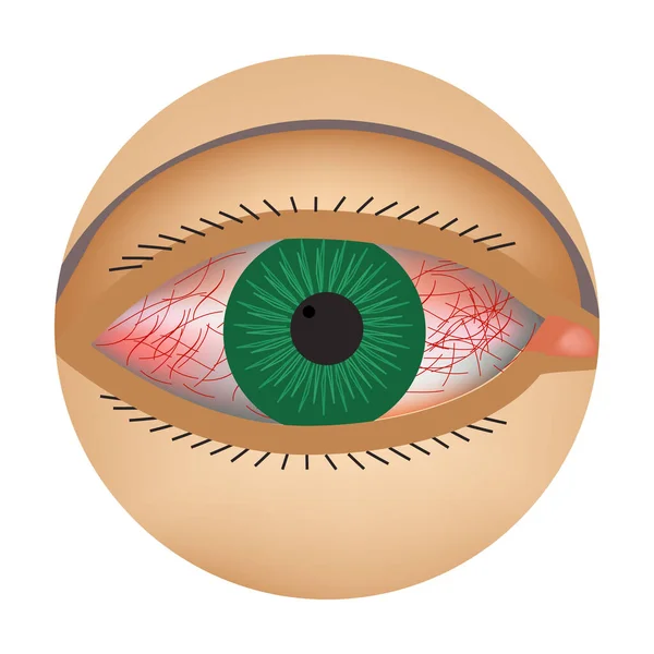 Κοκκινίλα των ματιών. Σύμπτωμα επιπεφυκίτιδας, αλλεργιών, φλεγμονής των ματιών. Εικονίδιο ερυθρότητας. Infographics. Εικονογράφηση διανύσματος σε απομονωμένο φόντο. — Διανυσματικό Αρχείο