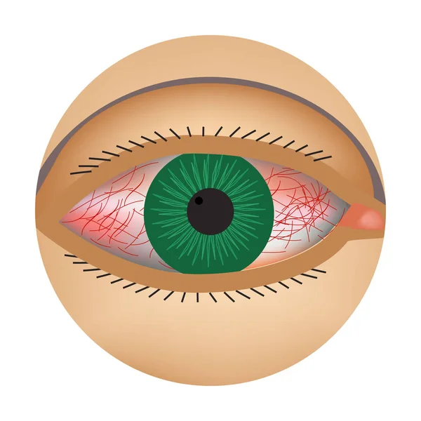 Vermelhidão dos olhos. Sintoma de conjuntivite, alergias, inflamação dos olhos. Ícone de vermelhidão ocular. Infográficos. Ilustração vetorial sobre fundo isolado . —  Vetores de Stock