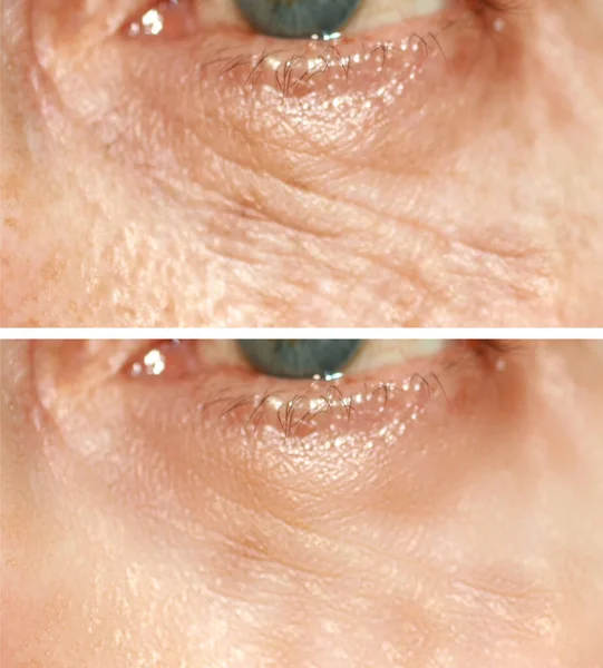 Rynkor under ögonen. Rynkor på huden i ansiktet. Smidiga ögonlock. Före och efter behandling med ett kosmetiskt förfarande — Stockfoto