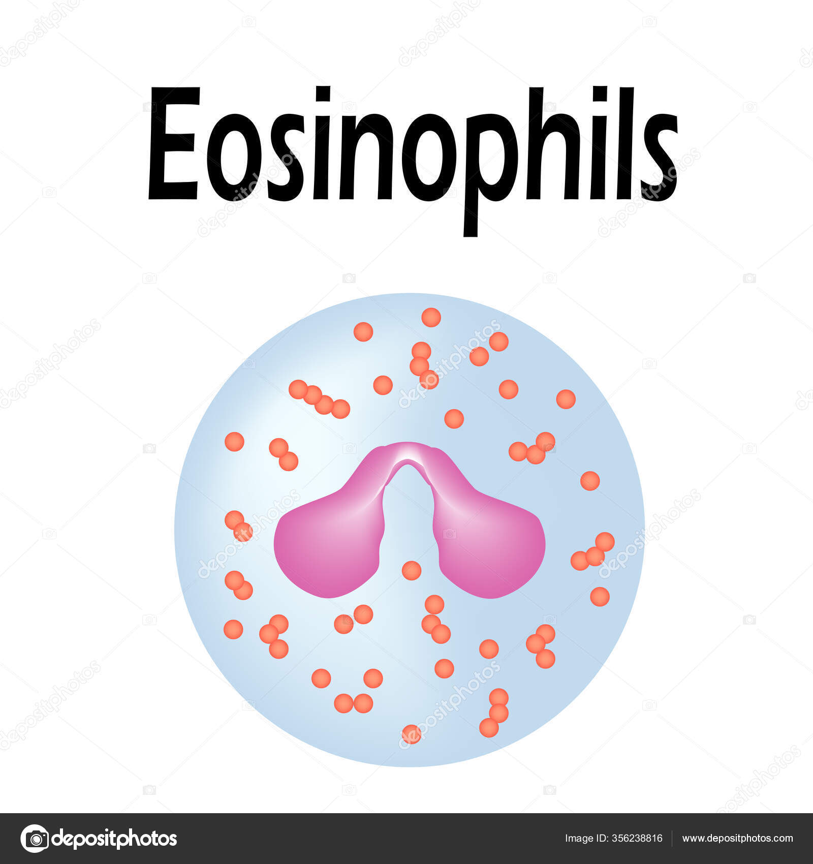 Eosinophils Eosinophilic Asthma: