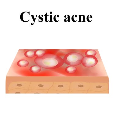 Kist sivilcesi. Kistin derisindeki sivilceler. Yüzünde dermatolojik ve kozmetik hastalıklar var. Bilgi grafikleri. İzole edilmiş arkaplanda vektör illüstrasyonu.