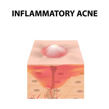 Kist sivilcesi. Kistin derisindeki sivilceler. Yüzünde dermatolojik ve kozmetik hastalıklar var. Bilgi grafikleri. İzole edilmiş arkaplanda vektör illüstrasyonu.