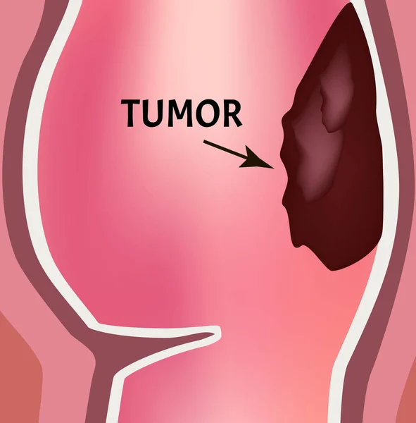 Un tumor en el recto. Estructura del recto del intestino. Tipos de pólipos y tumores en el colon. Infografías. Ilustración vectorial sobre fondo aislado . — Vector de stock