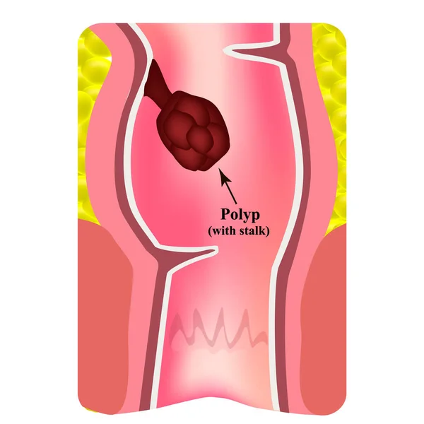 Pólipos no reto. A estrutura do reto do intestino. Tipos de pólipos no cólon. Infográficos. Ilustração vetorial sobre fundo isolado . — Vetor de Stock