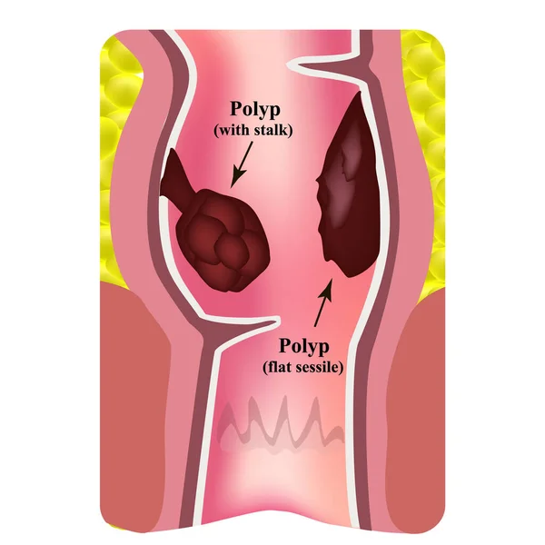 Pólipos en el recto. Estructura del recto del intestino. Tipos de pólipos en el colon. Infografías. Ilustración vectorial sobre fondo aislado . — Archivo Imágenes Vectoriales