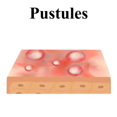 Kabarcıklar. Cildinde sivilce var. Yüz sivilcesinde dermatolojik ve kozmetik hastalıklar. Bilgi grafikleri. İzole edilmiş arkaplanda vektör illüstrasyonu.