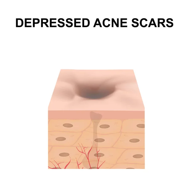 Cicatrizes atróficas. Cicatriz de acne. A estrutura anatômica da pele com acne. Ilustração vetorial sobre fundo isolado . —  Vetores de Stock