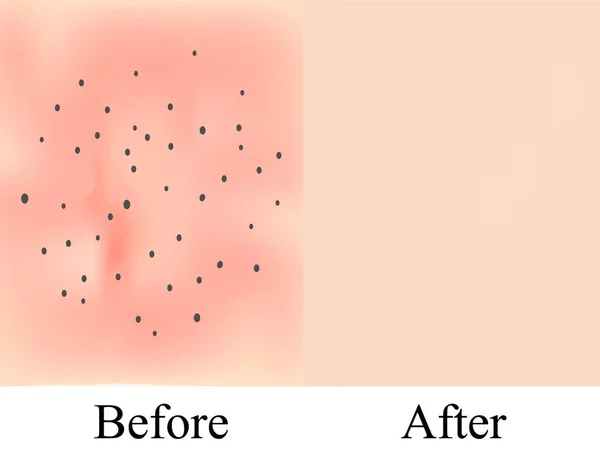 Textura de la piel con puntos negros de acné. Antes Después del acné. Fondo de piel. Infografías. Ilustración vectorial — Vector de stock