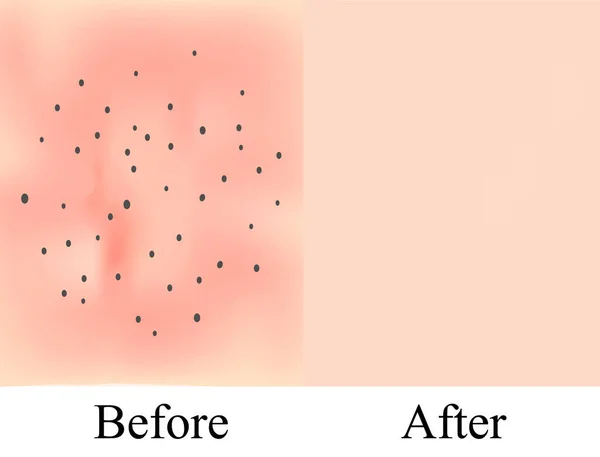 皮肤质地，粉刺的黑点。在粉刺之后皮肤背景。信息图形。矢量说明 — 图库矢量图片