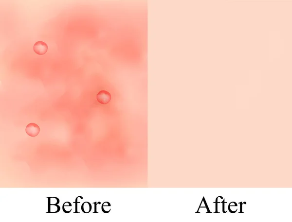 Texture, brufoli infiammati e acne. Prima Dopo cisti da acne. Esperienza della pelle. Infografica. Illustrazione vettoriale su sfondo isolato . — Vettoriale Stock