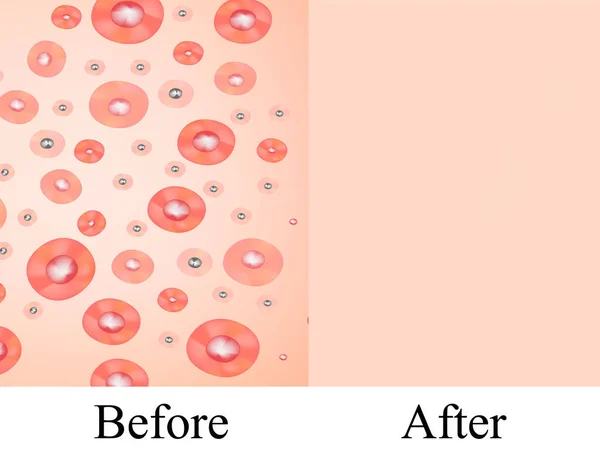 Texture, inflamed pimples and acne. Before After acne cysts. Skin background. Infographics. Vector illustration on isolated background.