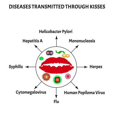Öpücüklerle bulaşan hastalıklar. Frengi, Herpes, Mononükleoz, Sitomegalovirüs, Helicobacter pylori, insan popilom virüsü, Hepatit A, Grip. Dünya Öpüşme Günü. Bilgi grafikleri. Vektör