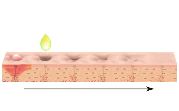 Cicatrici atrofiche. Cicatrice d'acne. La struttura anatomica della pelle con acne. Illustrazione vettoriale su sfondo isolato . — Vettoriale Stock