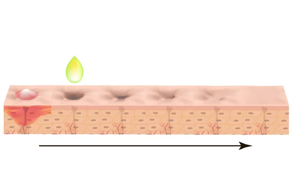 Атрофические шрамы. Шрам от прыщей. Анатомическая структура кожи с акне. Векторная иллюстрация на изолированном фоне . — стоковый вектор