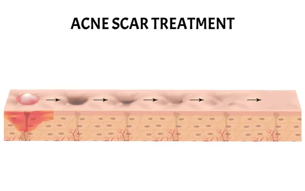 Cicatrizes atróficas. Cicatriz de acne. A estrutura anatômica da pele com acne. Ilustração vetorial sobre fundo isolado . —  Vetores de Stock