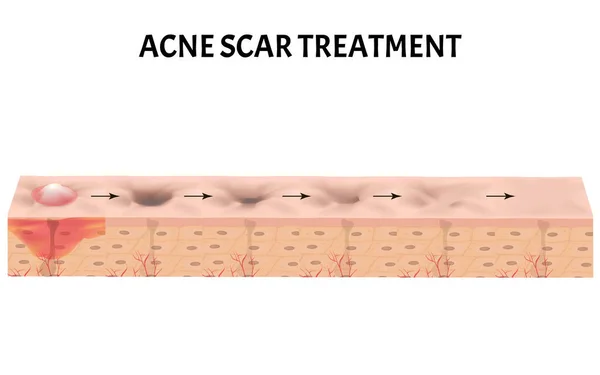 Atrophic scars. Acne scar. The anatomical structure of the skin with acne. Vector illustration on isolated background. — Stock Vector